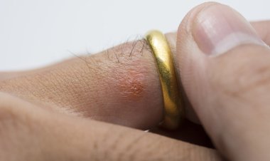 Dị ứng với vàng